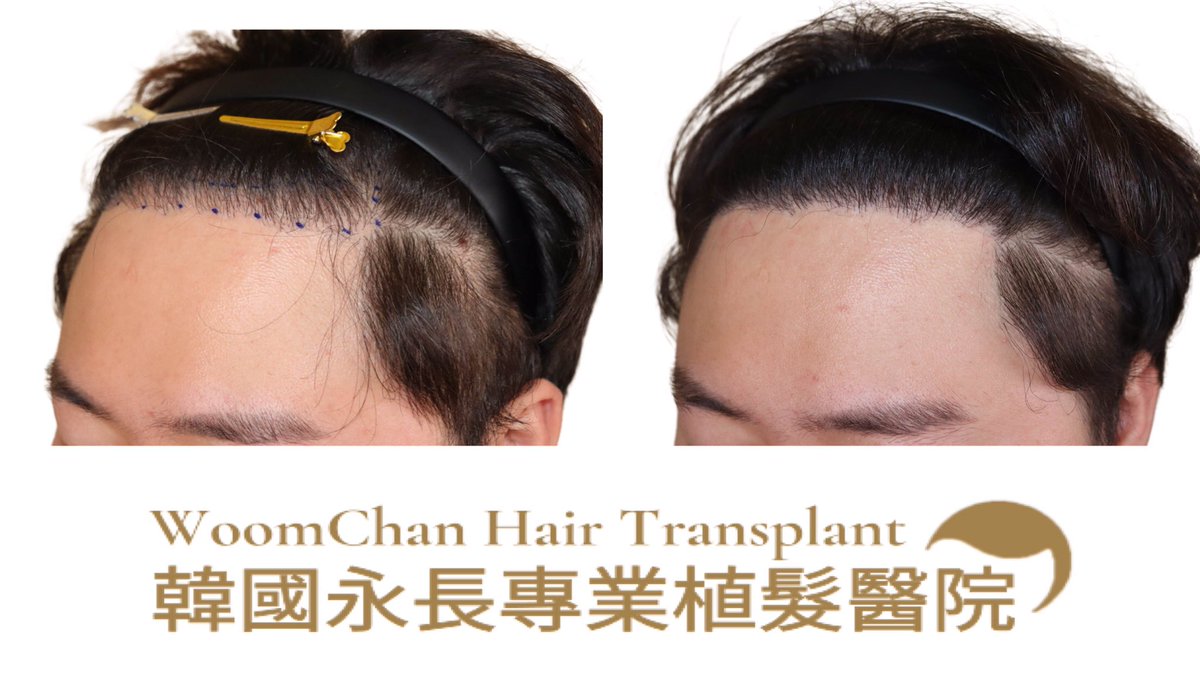 Woomchan88's tweet photo. 選擇韓國永長 2植是正確的選擇
微信 :woomchan 
line👉Woomchan 88
whatsapp: +821097895827
https://t.co/CHr7FRHGVl
 #韓國免剃髮植髮 #永長植髮 #woomchan永長植髮 #韩国植发医院 #韩国植髮費用 #hairtransplantsurgery #韓國免剃发植发 #FUE免剃发植 #韓國植髮 #台灣植髮 https://t.co/RyUKyXCyKf