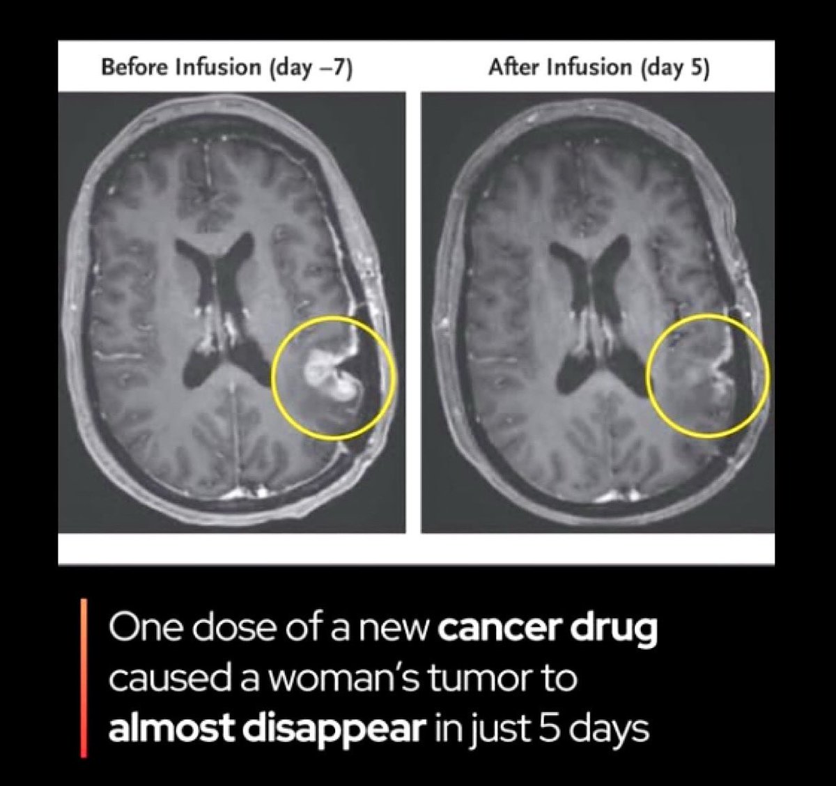 Doctors at Massachusetts General Hospital have reported a "dramatic and rapid" regression of tumors in the first three patients who received a next-generation CAR T-cell therapy for glioblastoma, one of the most aggressive forms of brain cancer.

This therapy, known as