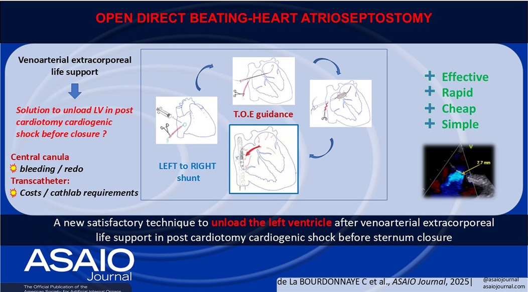 asaiojournal's tweet image. Open Direct Beating-Heart Atrioseptostomy: Left Heart Unloading Under Extracorporeal Life Support
ASAIO Journal 71(10):p e141-e143, October 2025. | DOI: 10.1097/MAT.0000000000002492
journals.lww.com/asaiojournal/f… 
#ASAIO