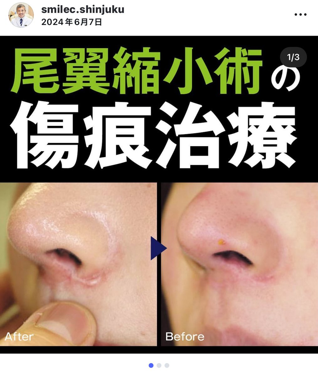 今話題の整形後の傷跡問題…🫣
人中短縮、小鼻縮小、切開リフト、鼻整形の際の肋軟骨、脂肪吸引の傷跡など色々ある😨この前傷跡治療で有名なスマイルクリニックの西川先生に話聞いてきたけどレーザーで治療可能だそう✌️ワイも切開リフトの傷跡診てもらったけどかなり希望持てそう！！
#傷跡治療 https://t.co/9k4qzleuxS