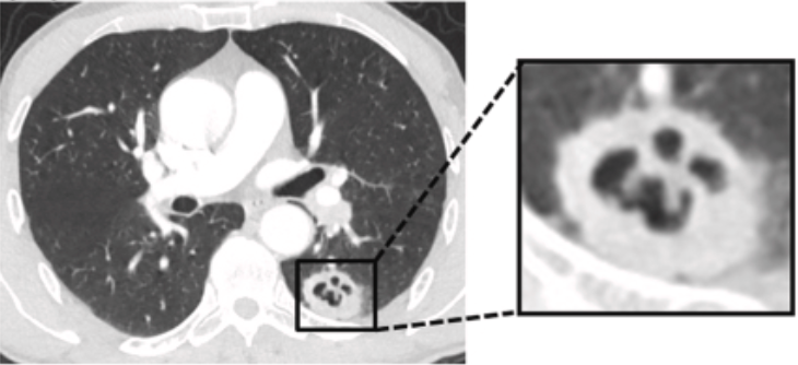 MarcGozlan's tweet image. Au scanner, le Halloween pumpkin sign (signe de la citrouille d’#Halloween) décrit l’aspect d’une masse pulmonaire tumorale avec nécrose centrale, typique de certains cancers bronchiques avec parois internes épaissies et irrégulières.
 pmc.ncbi.nlm.nih.gov/articles/PMC11… #oncologie #poumon