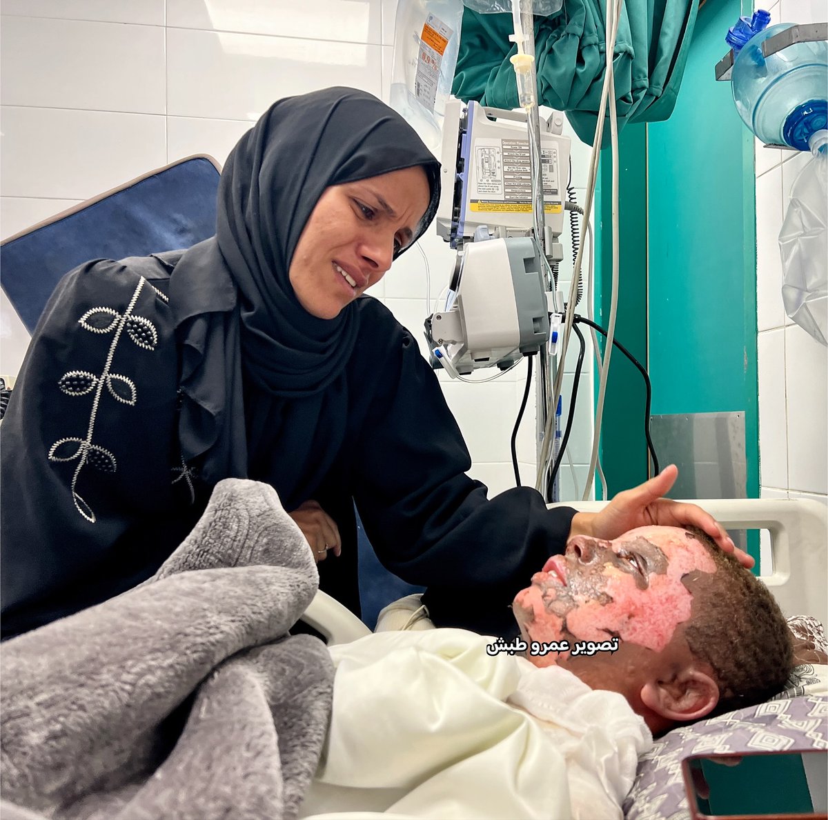 Timesofgaza's tweet image. Majd Abu Habib, an 11-year-old boy from Khan Younis, suffered devastating injuries after a suspicious object left behind by the Israeli army exploded near him. He sustained severe burns covering 35% of his body, deep third-degree burns on his right side, and second-degree burns…