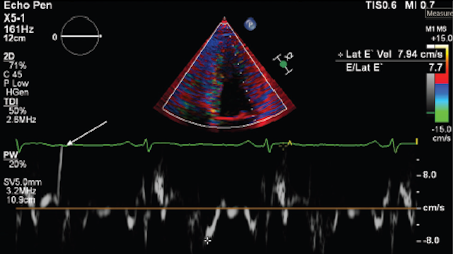radcliffeCARDIO's tweet image. 📚New #USCJournal Article: "Mitral Annular Disjunction: Case Report and Literature Review"

📚 Just Published!

🔓Access it here 👉 ow.ly/8cNB106pbjB

@CardioNerds #Electrophysiology #Arrhythmia #MedEd #CVImaging