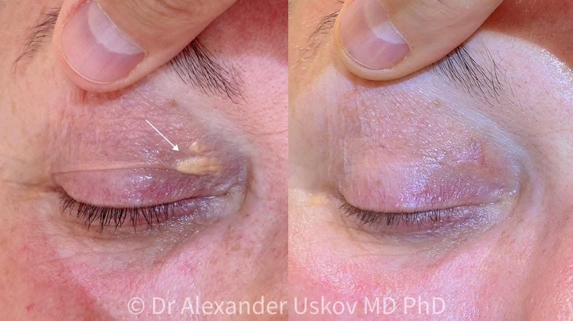 DoctorUskov's tweet image. Laser removal helps to get rid of xanthelasma on the eyelids. It’s a quick and safe method that restores smooth skin -often, just one session is enough to see results!

#uskovprotocol #laseraesthetics #xanthelasmaremoval #laserremoval #healthyskin #aesthetics #cosmetologist