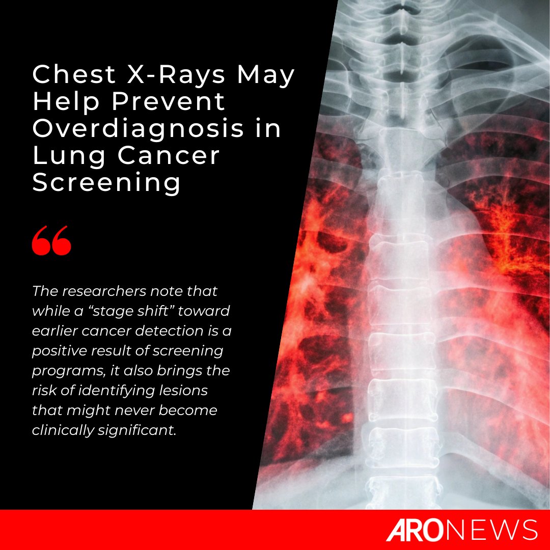 Applied_RadOnc's tweet image. As more individuals—including non-smokers—pursue low-dose CT (LDCT) screening, the detection of subsolid nodules has increased, raising concerns about unnecessary treatment and patient anxiety.
🔗 ow.ly/sl5X50XjZQk
#LungCancer #LDCT #CancerScreening