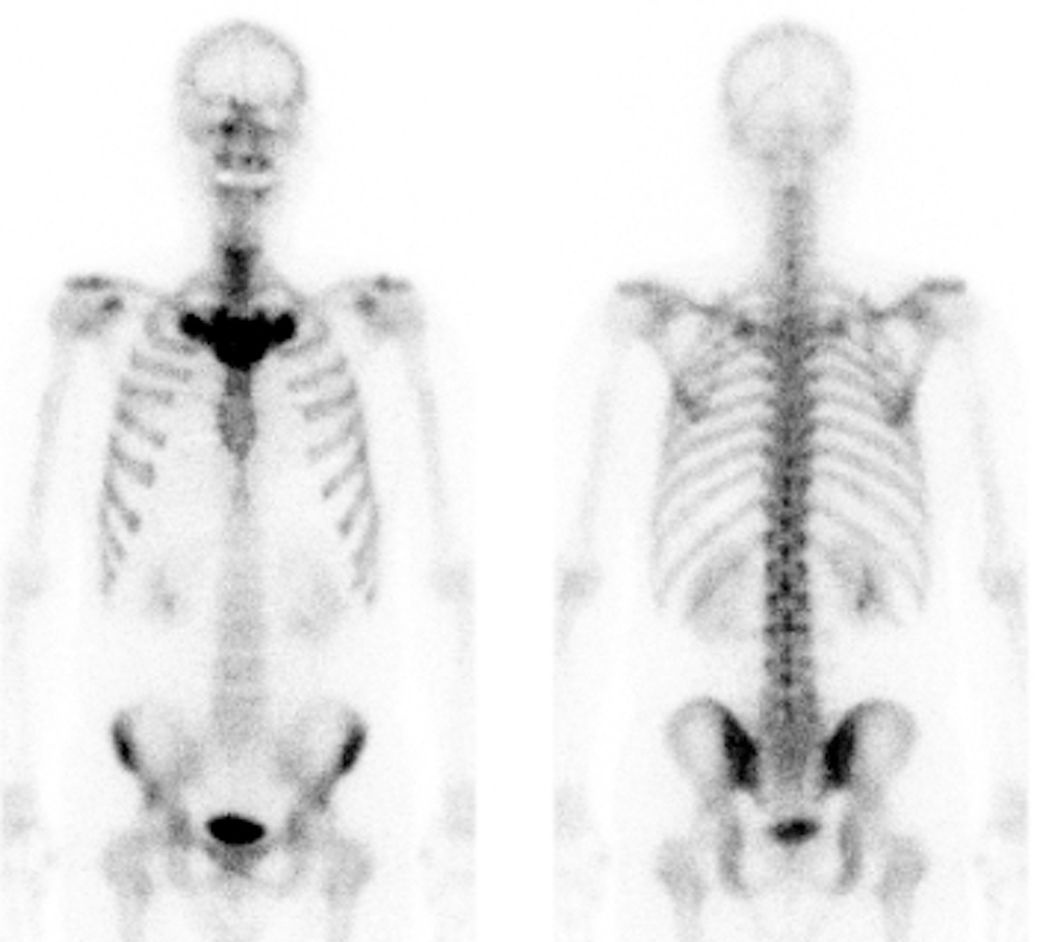 docakx's tweet photo. Classic sign on bone scintigraphgy
Patient has palmoplantar pustulosis.
What is thisโ๏ธ
Image from
DOI : 10.1136/bcr-2019-233221 https://t.co/cYfGySpvts