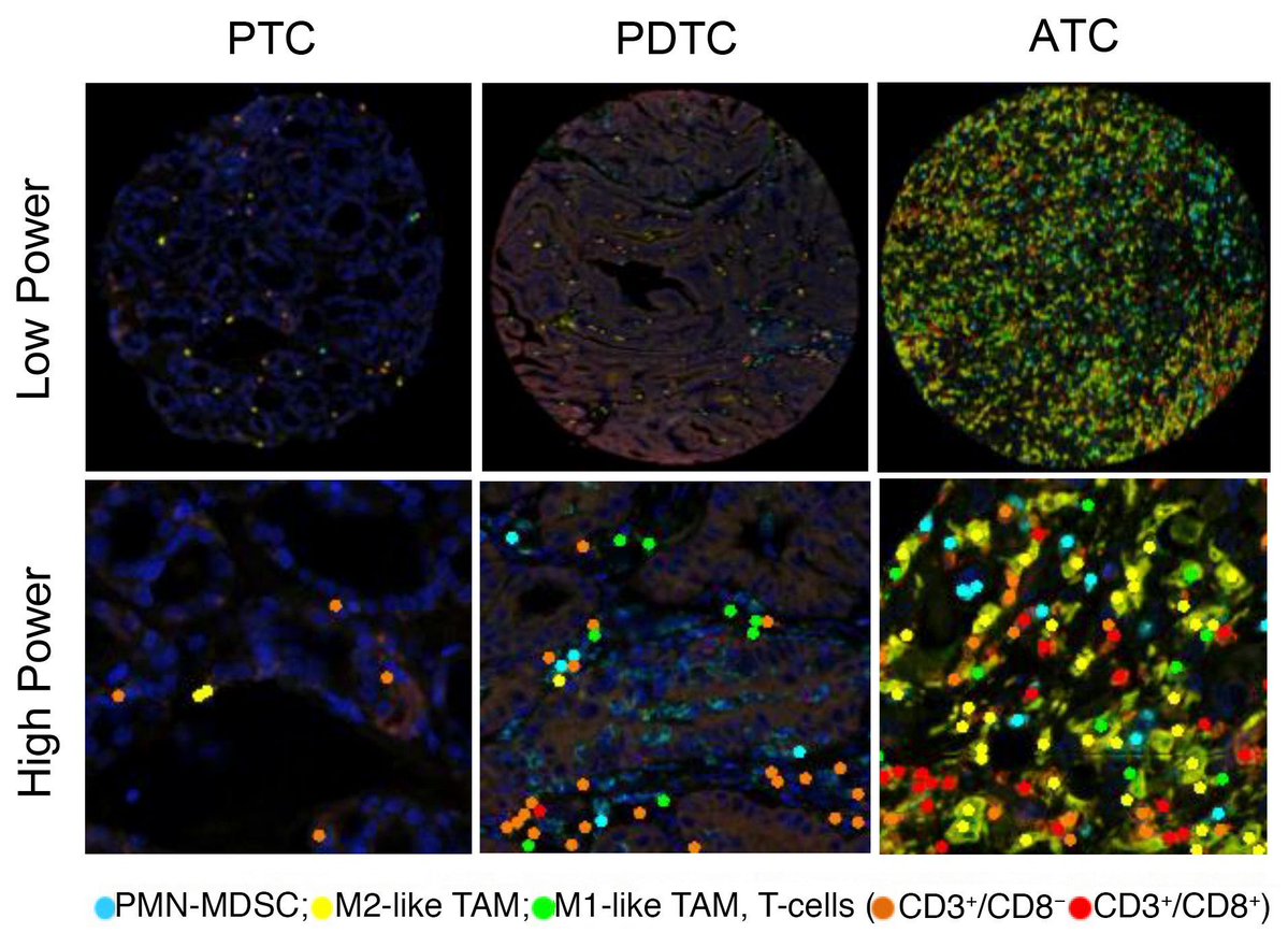 Little progress has been made in the treatment of anaplastic thyroid cancer

<a href="/VeraTiedje/">Vera Tiedje</a> <a href="/Gnana_Krish/">Gnana Krishnamoorthy</a> et al. <a href="/MSKCancerCenter/">Memorial Sloan Kettering Cancer Center</a> now find mice with aggressive ATC respond to the inhibitor combination dabrafenib/trametinib by affecting cancer cell MHCII expression &amp; increasing T-cell