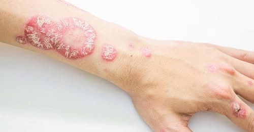 elmisilpy's tweet photo. 🩺 En el Día Mundial de la Psoriasis, la dermatóloga Mariana Barbetti llamó a la prevención y al diagnóstico temprano: “Cada año crecen los casos en Formosa; tengo unos mil pacientes”. https://t.co/4IrrJ7jU7D