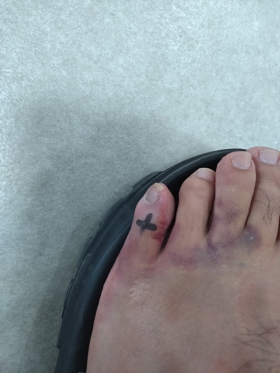 initial33a's tweet image. 労災の診断書をいただくため病院へ
お医者さまから、レーザー当てて細胞活性化することで、骨が引っ付く時間が半分くらいになる❗️
と言われて、早速チャレンジ。
20分待つだけ。
休業中は毎日通院することにした。
結果はいかに？？