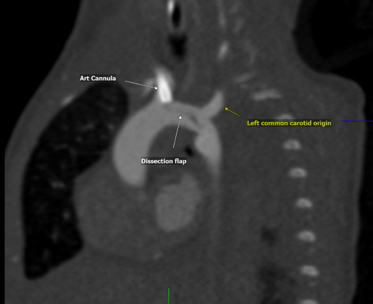 asaiojournal's tweet image. Aortic Dissection in a Neonate Receiving Extracorporeal Life Support Therapy: A Case Report
ASAIO Journal 71(10):p e144-e146, October 2025. | DOI: 10.1097/MAT.0000000000002306
journals.lww.com/asaiojournal/f… 
#ASAIO