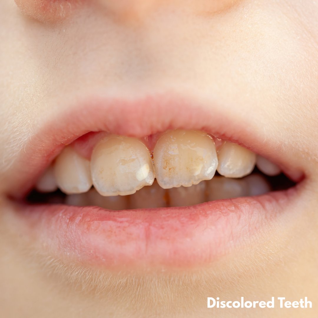 Are Discolored Teeth a Sign of Poor Dental Health?

ow.ly/mQiq50Xec7n
#discoloredteeth #dentalcare #oralhealth #smile
