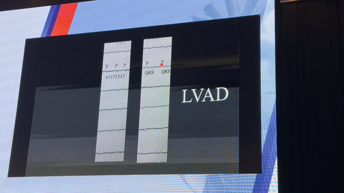 gonzaeperez's tweet image. Congreso #LAHRS2025 
#ECGfirst a cargo del Dr. Josep Brugada 

Impresionante ECG sobre pac con LVAD que ingresa con FV y ritmo sinusal y disnea 

Se puede observar el ECG post CVE en ritmo sinusal con QRS muy pequeños 

@LAHRSonline1 @carritmiasarg