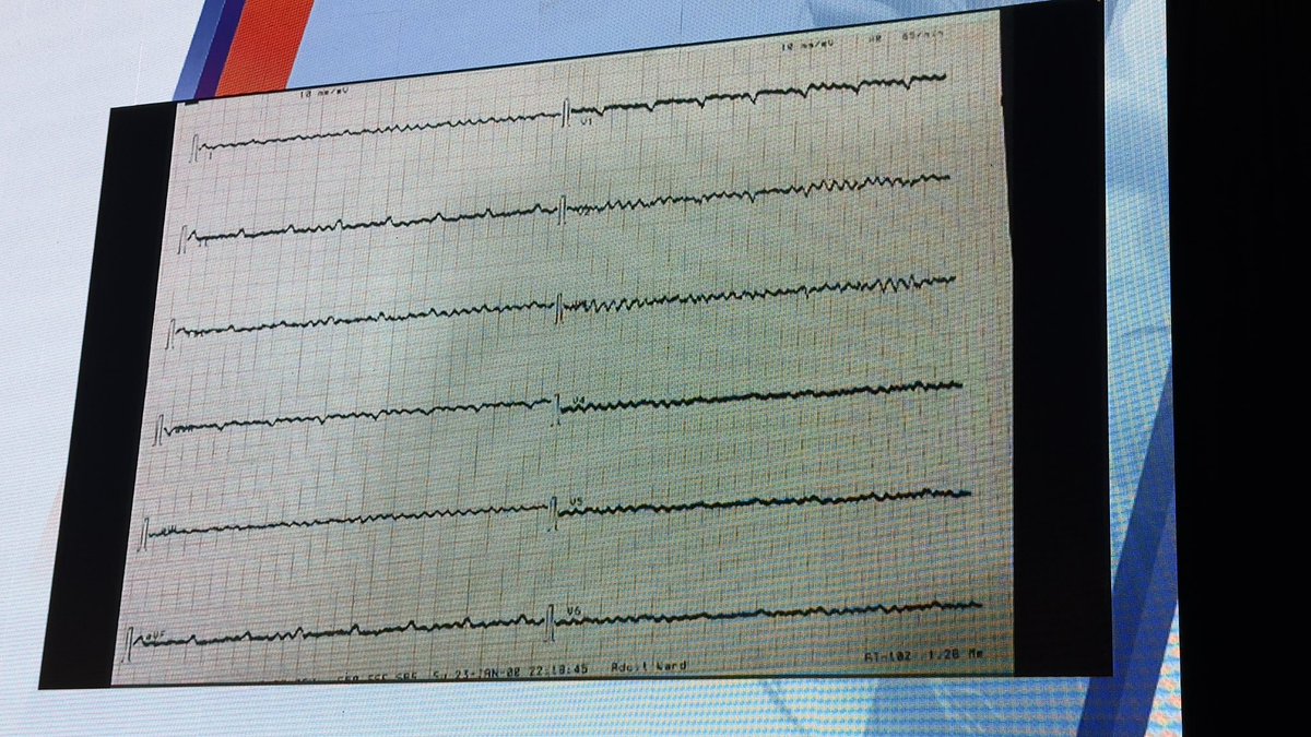 gonzaeperez's tweet image. Congreso #LAHRS2025 
#ECGfirst a cargo del Dr. Josep Brugada 

Impresionante ECG sobre pac con LVAD que ingresa con FV y ritmo sinusal y disnea 

Se puede observar el ECG post CVE en ritmo sinusal con QRS muy pequeños 

@LAHRSonline1 @carritmiasarg