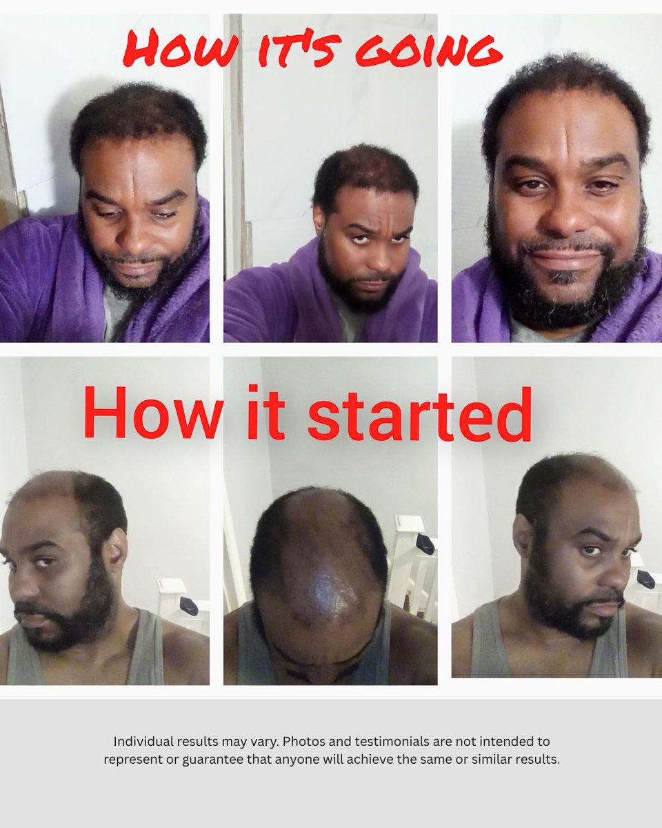 HRSofATL's tweet image. A year of growth, patience, and confidence. 🌱 See how far we’ve come, from start to strong!

#HowItStartedVsHowItsGoing #AfricanAmericanHairTransplant #hrsatl