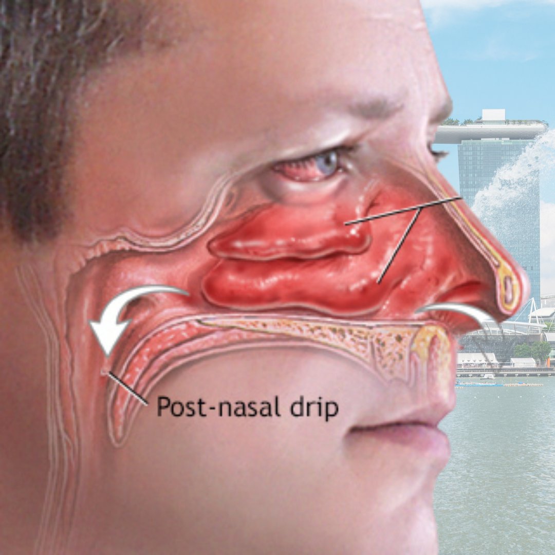 lowmegatron's tweet image. Hypothyroidism causes nasal congestion.

This association observed in humans is confirmed in experimental hypothyroidism in rats.

“In patients with hypothyroidism, clinical changes also occur in the ear-nose-throat region... Hypertrophy of mucous glands and increase in the basal…