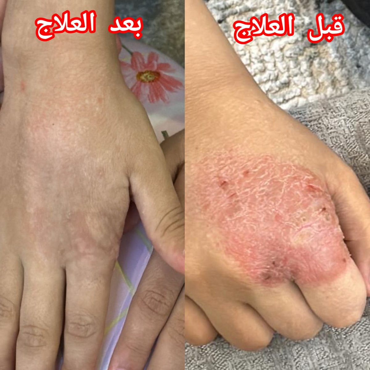 قبل وبعد العلاج 👌
تحت إشراف الدكتور حسن العماري استشاري طب الأسرة والأمراض الجلدية 🌹
.
 
.

#مشكلات_البشرة 
#أمراض_جلدية
#اكزيما #جلدية
#كاريزما76