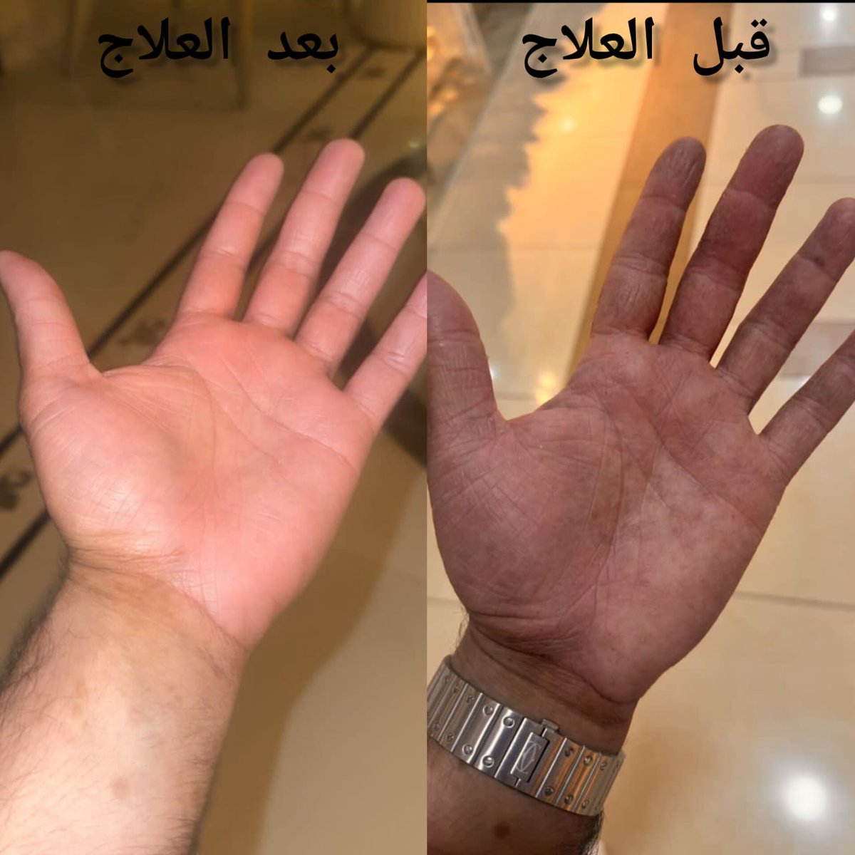 قبل وبعد العلاج 👌
تحت إشراف الدكتور حسن العماري استشاري طب الأسرة والأمراض الجلدية 🌹
.
 
.

#مشكلات_البشرة 
#أمراض_جلدية
#اكزيما #اكزيما_جلدية
#كاريزما76