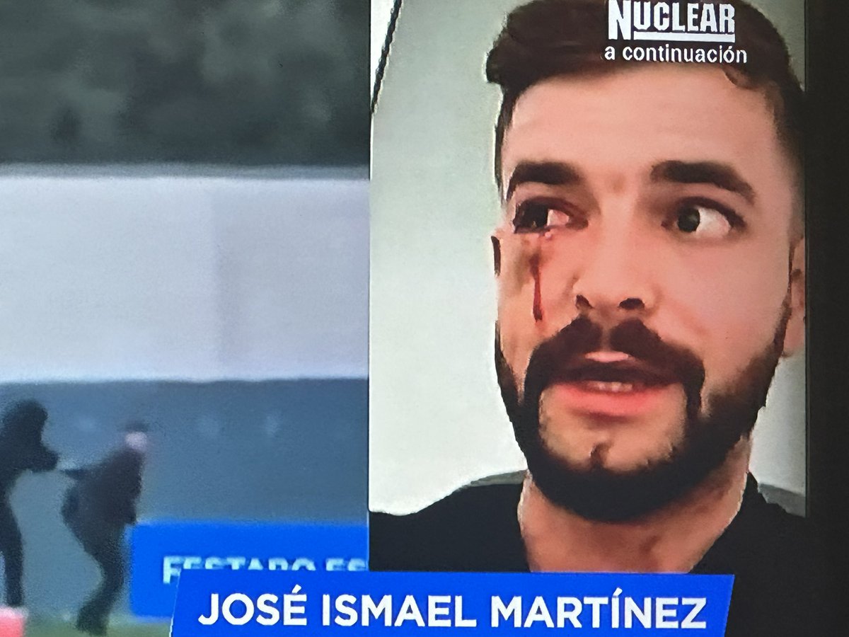 Así han dejado los salvajes de extrema izquierda al periodista de El Español. 
En este momento está en el hospital haciéndole pruebas.  
Y lo peligroso dicen que es la derecha, que nos cuenten otra película.