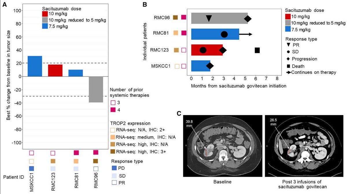 <a href="/kaydaustin/">Katie Coleman</a> <a href="/ERPlimackMD/">Elizabeth Plimack MD</a> <a href="/crisbergerot/">Cristiane D Bergerot, PhD, FASCO</a> <a href="/NazliDizman/">Nazli Dizman</a> <a href="/BradMcG04/">Bradley McGregor</a> <a href="/g_procopio_/">Giuseppe Procopio</a> <a href="/maughanonc/">Benjamin L Maughan</a> <a href="/salvolarosa/">Salvatore La Rosa</a> <a href="/LabGenovese/">Giannicola Genovese MD, PhD</a> <a href="/JAMouabbi/">Jason A. Mouabbi MD</a> <a href="/IamLinghua/">Linghua Wang, MD, PhD</a> <a href="/OAlhalabiMD/">Omar Alhalabi, MD</a> <a href="/perelli_luigi/">Luigi Perelli</a> <a href="/rahulshethmd/">Rahul Sheth</a> <a href="/ChadTangMD/">Chad Tang, MD</a> <a href="/TiansterZhang/">Tian Zhang, MD, MHS, FASCO (@tiansterzhangmd.bsky)</a> <a href="/QingZhangLab/">Qing Zhang</a> <a href="/BCottaMD/">Brittney Cotta, MD</a> <a href="/Daniel_J_George/">Dan George</a> <a href="/DrDanielHeng/">Daniel Heng</a> <a href="/priyaraomd/">Priya Rao, MD</a> <a href="/UroDocAsh/">Ashish M. Kamat, MD, MBBS</a> <a href="/drmehrarohit/">ROHIT MEHRA</a> <a href="/ED_PhD_/">Eleonora Dondossola,PhD</a> <a href="/DanielFrigo/">Daniel E. Frigo, Ph.D.</a> <a href="/rovingatuscap/">Samson W. Fine, MD</a> <a href="/katy_beckermann/">Katy Beckermann</a> <a href="/shilpaonc/">Shilpa Gupta</a> <a href="/AmandaNizamMD/">Amanda Nizam, MD</a> <a href="/ZiadBakouny/">Ziad Bakouny, MD, MSc</a> 5/5 Clinical evidence: Sacituzumab govitecan in 4 heavily pretreated RMC pts → 1 PR (~5.3 mo) + 2 SD; median PFS 2.9 mo. Early, small-n but proof that biology-guided targeting can bend the curve for RMC.  Next: more RMC-specific trials based on these biological insights.