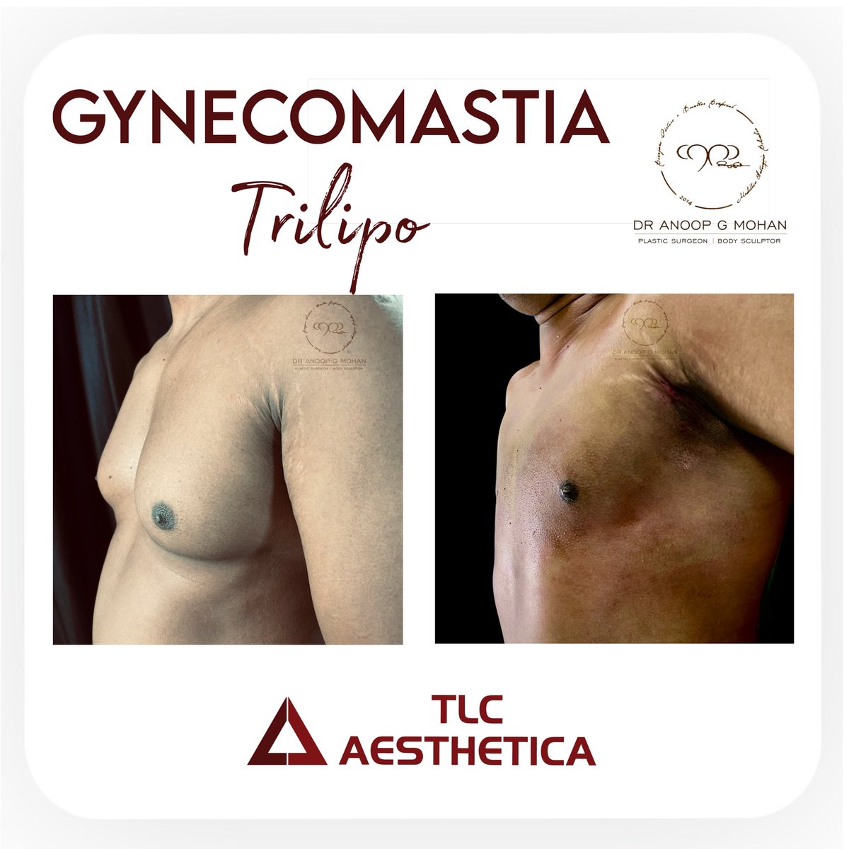 #VaserLipo #bodysculpting #hdlipo #AestheticSurgery #PlasticSurgeon #tlcaesthetica #TransformWithTLC #dranoopgmohan #gynecomastia #lipo #bbl #cosmeticsurgeon
