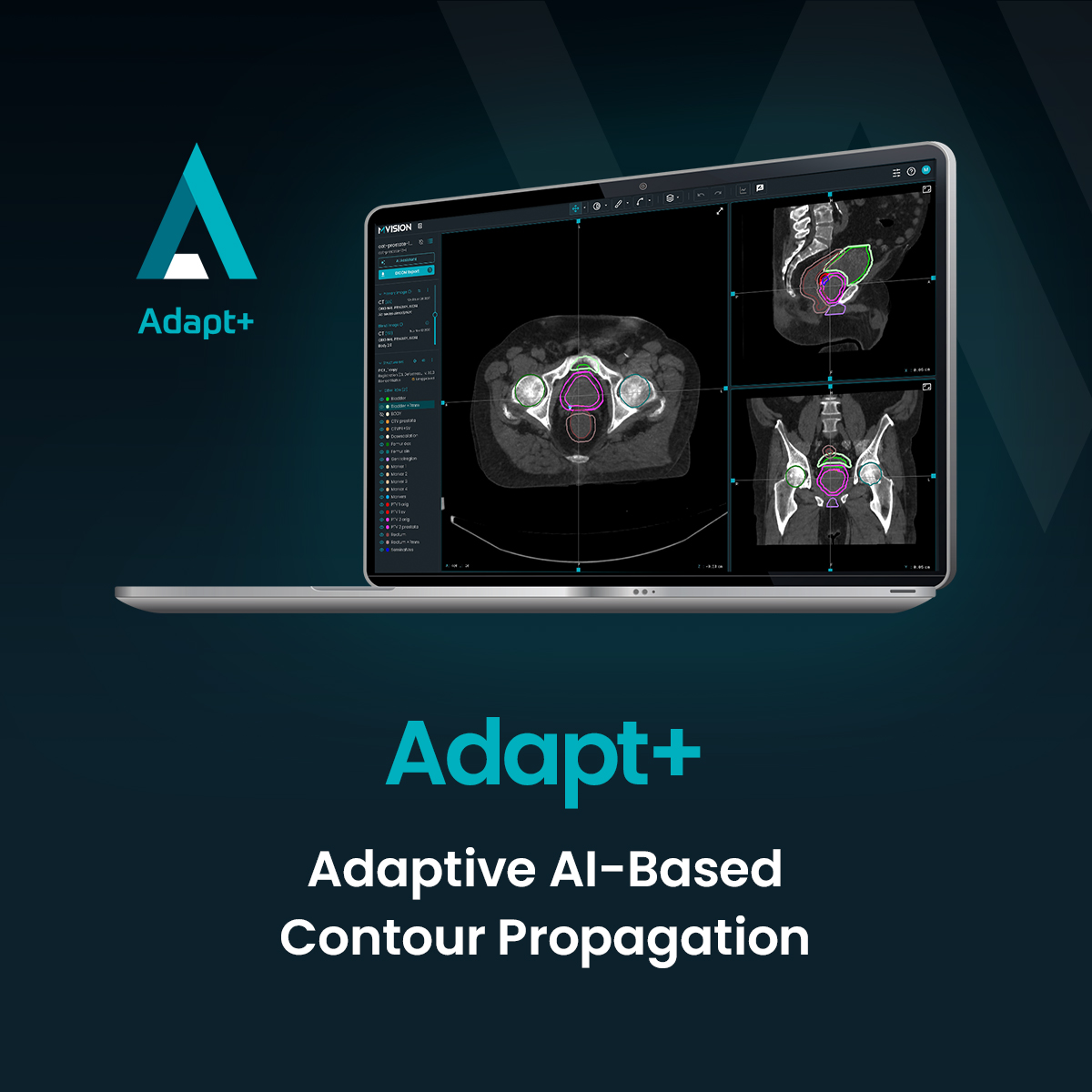 mvisionai's tweet image. Workspace+ unites 4 AI modules that bring automation &amp;amp; consistency to #radiotherapy treatment preparation— helping clinicians reduce manual effort, maintain standardised contours, &amp;amp; strengthen confidence in workflows.

*CE-marked; this product is not available in all markets.