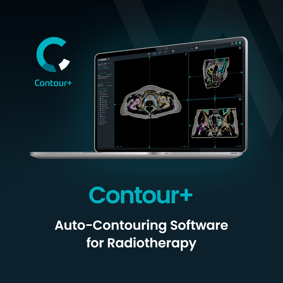 mvisionai's tweet image. Workspace+ unites 4 AI modules that bring automation &amp;amp; consistency to #radiotherapy treatment preparation— helping clinicians reduce manual effort, maintain standardised contours, &amp;amp; strengthen confidence in workflows.

*CE-marked; this product is not available in all markets.