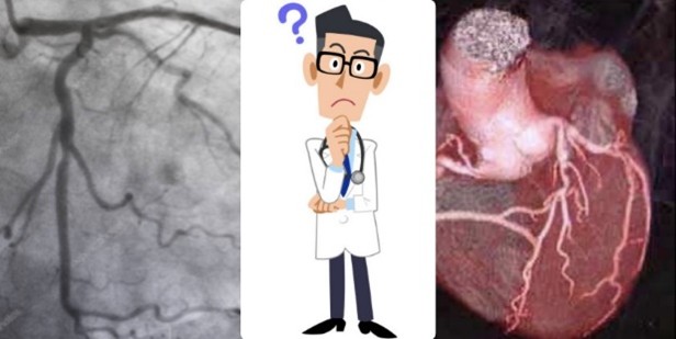 gitalcardiol's tweet image. Coronaropatia non ostruttiva nel paziente asintomatico: quando l’evidenza manca, il buon senso guida la clinica. Il punto di vista di Rubboli e Morici per orientarsi in un terreno ancora incerto.
#GIC #CCTA #ASCVD
giornaledicardiologia.it/archivio/4585/…