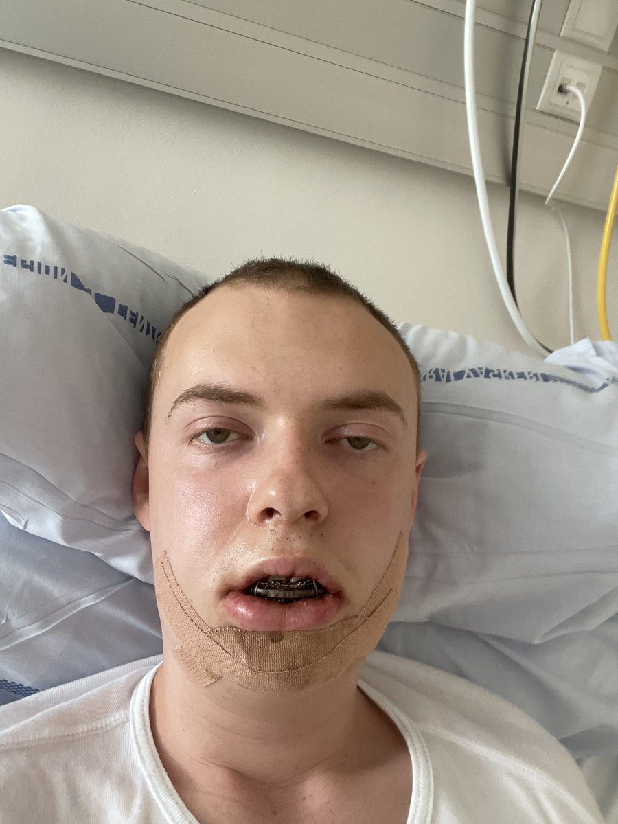 capper_enersen's tweet photo. Mig mod staten, først tog de 6 tænder, nu har de i et snig angreb taget, overkæbe, underkæben og min hage. https://t.co/AdEvgVhQGA