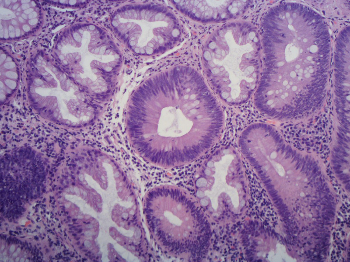 Common neighbours but infrequent bed partners...Hyperplastic polyp and tubular adenoma colliding in the same biopsy #GIPath #PathTwitter