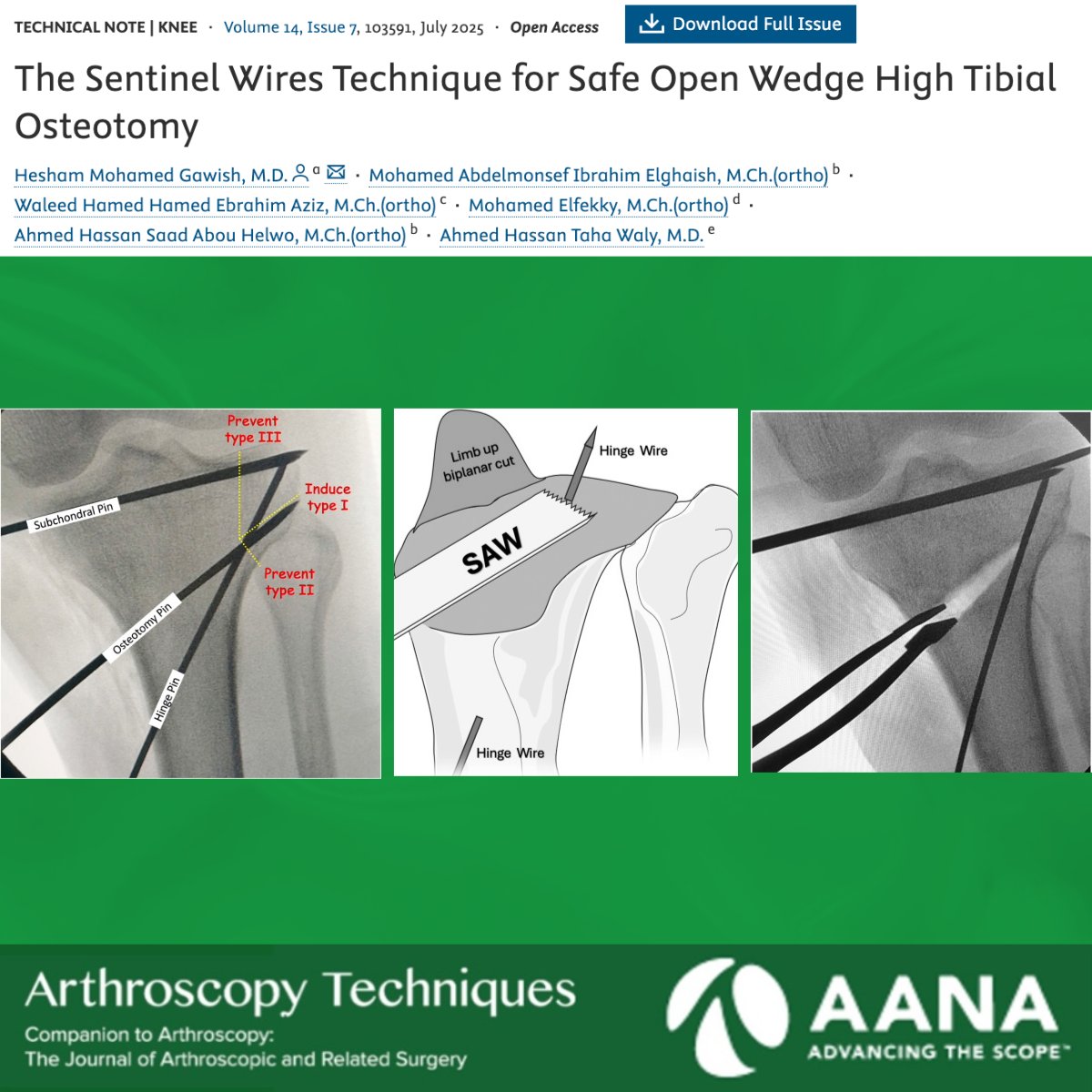 Check out this technical note recently published in ATech describing the use of a hinge wire in addition to a subchondral wire to prevent hinge fractures in HTO. 

ow.ly/KUCQ50XkOEV
#ortho #knee #arthroscopy #sportsmedicine #jointpreservation @eluafm