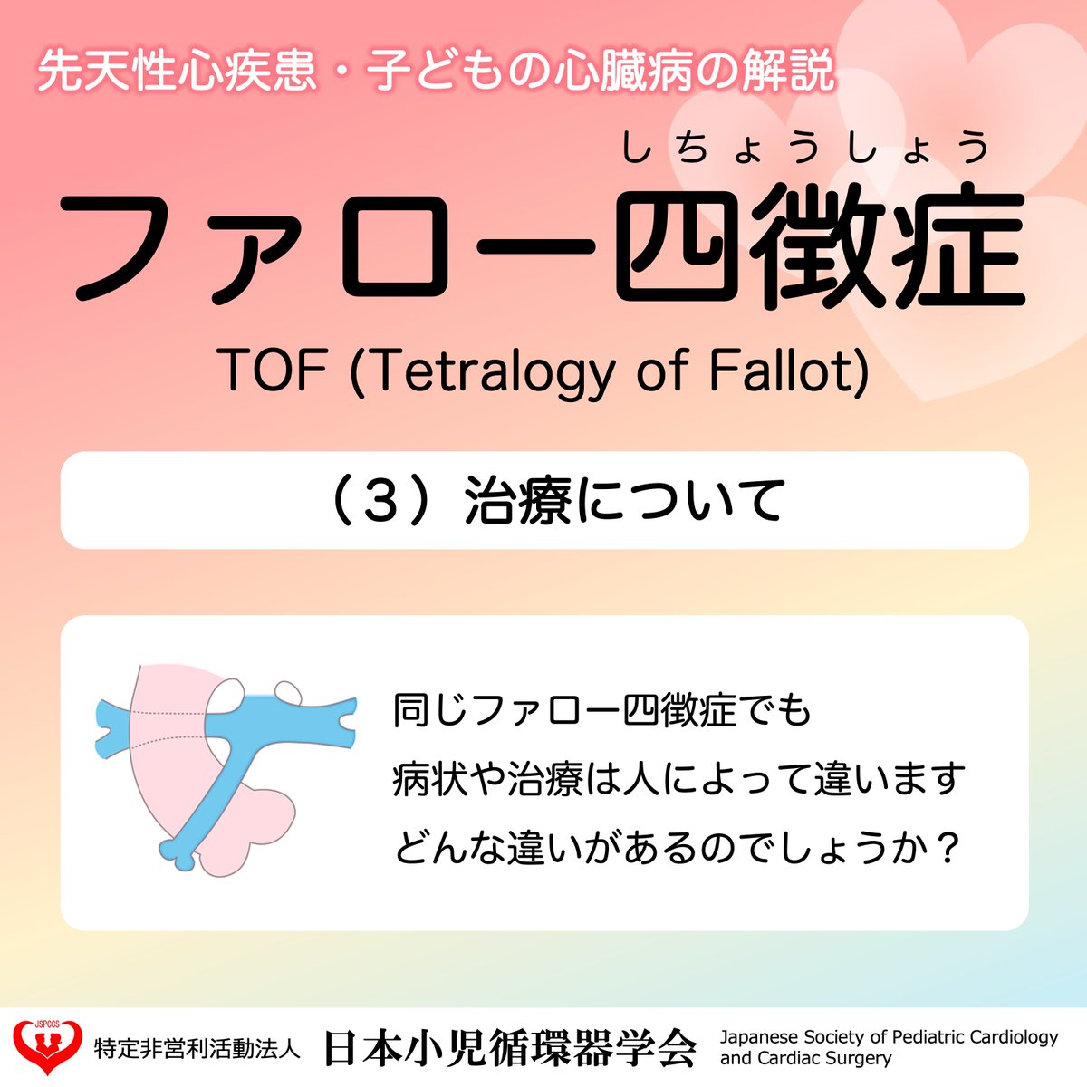 JSPCCS's tweet image. 公式Instagramからです！

今回は…

＼ファロー四徴症の治療について／

どんな時にBTシャント？どんな時にラステリ手術？
同じファロー四徴症でも、手術の術式や手術のタイミングが違います。

↓↓ 説明はこちら ↓↓
instagram.com/p/DQeQ1kik_xn/…

#ファロー四徴症
#日本小児循環器学会
