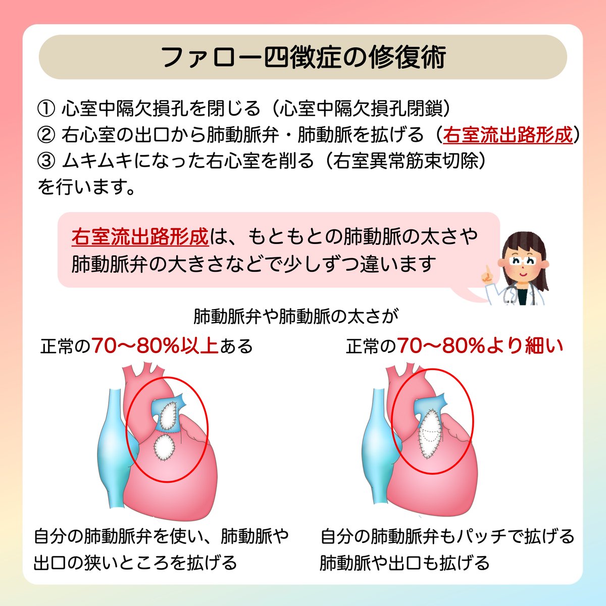 JSPCCS's tweet image. 公式Instagramからです！

今回は…

＼ファロー四徴症の治療について／

どんな時にBTシャント？どんな時にラステリ手術？
同じファロー四徴症でも、手術の術式や手術のタイミングが違います。

↓↓ 説明はこちら ↓↓
instagram.com/p/DQeQ1kik_xn/…

#ファロー四徴症
#日本小児循環器学会