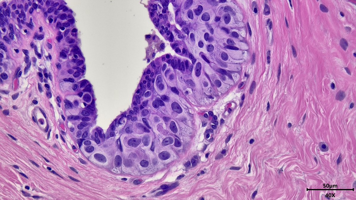 Happy Halloween #pathx and #PathTwitter ! 👻🎃Something wicked is lurking in this duct 🧌, pagetoid spread of DCIS #breastpath