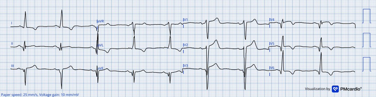 nadavsh0's tweet image. LVH makes it harder for us to appreciate st-t changes.

This 70 year old complained of chest pain this is ECG #1, done at his house by EMS. Do you recognize the alarming signs here?

@smithECGBlog
@PendellM
@RobertHermanMD
@PMcardioApp
@EM_RESUS
#ECG #ECGChallenge
