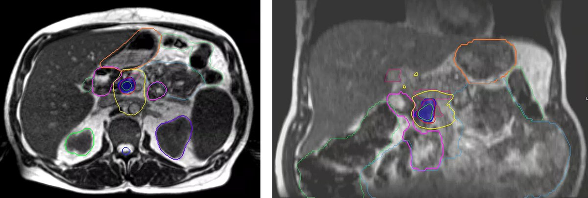 Applied_RadOnc's tweet image. Portal Vein Stenosis Following Neoadjuvant Therapy With MRgART and Surgery for Pancreatic Cancer: A Case Report
🔗 ow.ly/YMrt50XkIq7 
#RadOnc #RadOncEd #CaseStudy #RadiationOncology