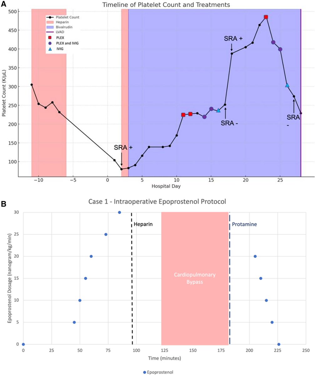 asaiojournal's tweet image. Intraoperative Epoprostenol in Type II Heparin-Induced Thrombocytopenia During Left-Ventricular Assist Device Implantation: A Case Series and Review of Literature
ASAIO Journal 71(10):p e147-e152, October 2025. | DOI: 10.1097/MAT.0000000000002356
ow.ly/LZgy50Xkfxc
#ASAIO