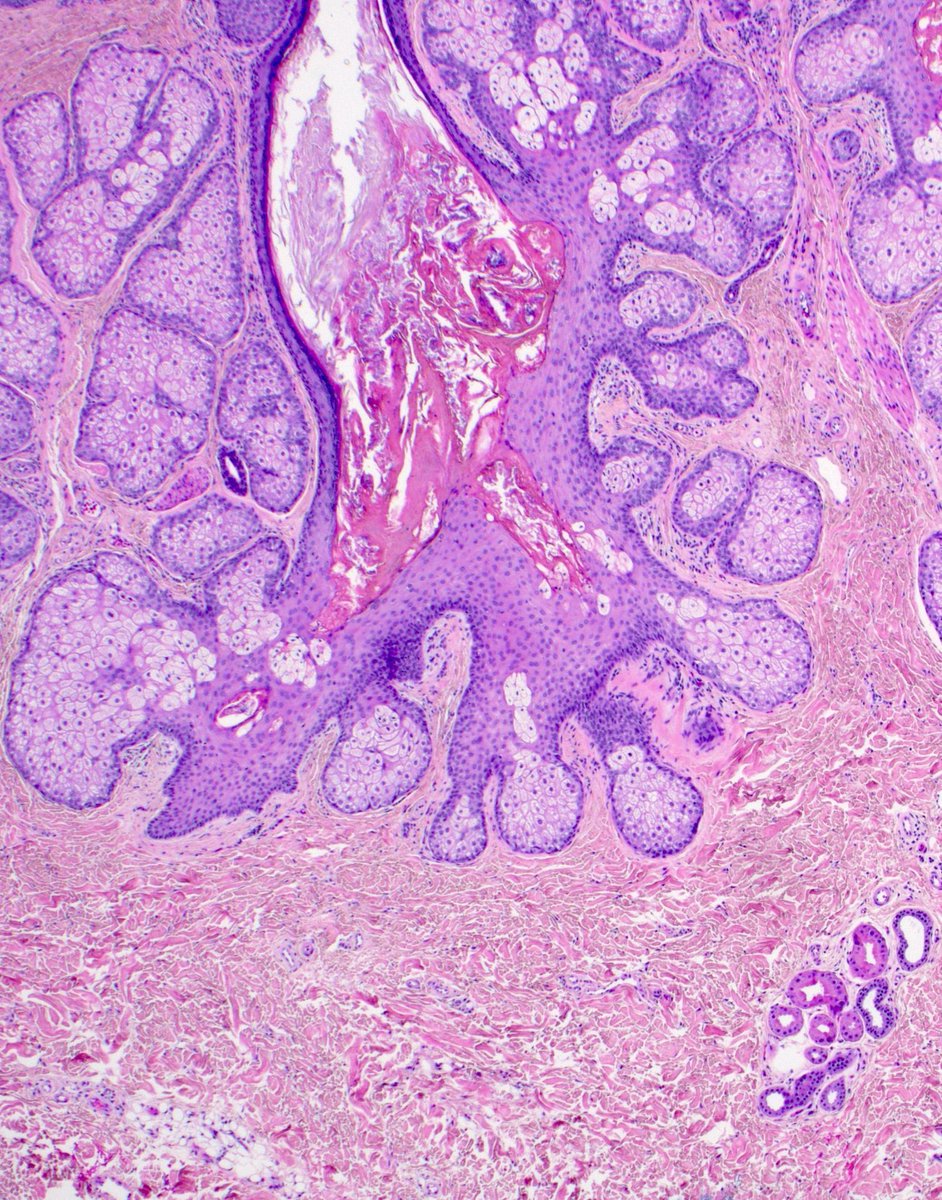 Scalp. #TooCloseToDiagnose? Clue at bottom right
Answer ✅ youtube.com/watch?v=7M7Ol5… 
More pics: kikoxp.com/posts/17171
Digital slide🔬 (different case): kikoxp.com/posts/13673
#pathology #pathologists #pathTwitter #dermpath #dermatology #dermtwitter