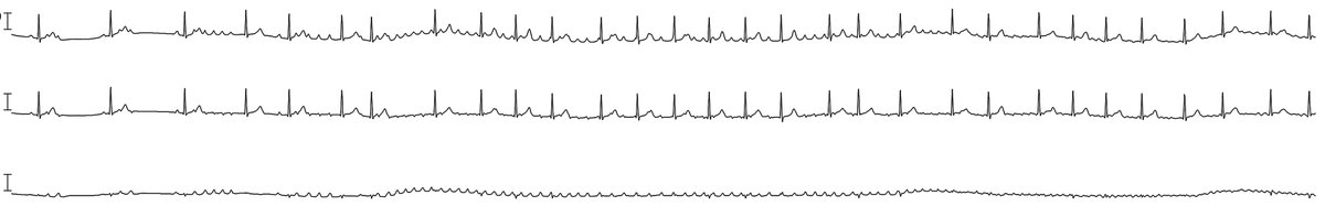 A 45-year-old man with intermittent palpitations. Holter strip, 3 leads, 30 seconds long. What does the rhythm look like?