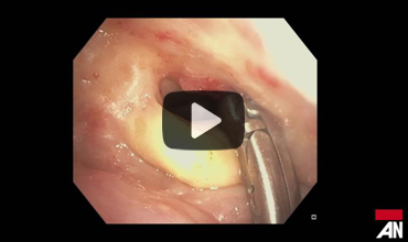 anesthesianews's tweet photo. 🎥 NEW #AirwayOnDemand episode! Dr. William Rosenblatt of @YaleMed walks through the use of THRIVE in a very difficult airway case. Watch now ➡️ https://t.co/DEAf31sMBU #Anesthesiology #AirwayManagement #MedEd https://t.co/Y7EpPvDaNE