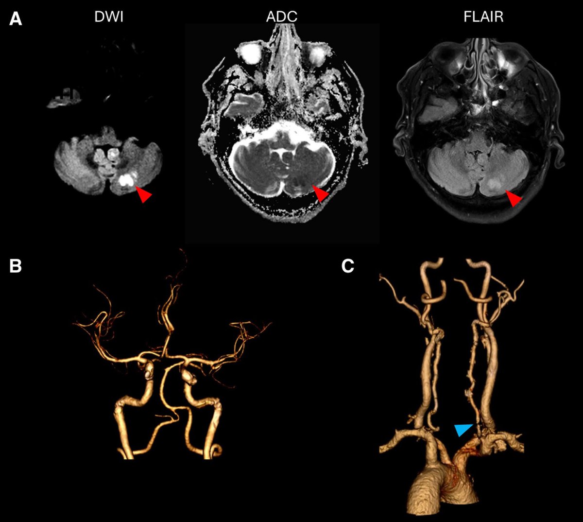 #Stroke Illustrative Teaching Case outlines the potential role of GLP-1 RAs in primary stroke prevention. ahajrnls.org/437EYWN