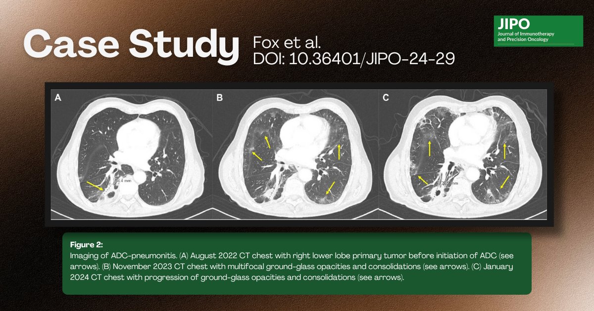 JIPOEditors's tweet image. #JIPO case report by Fox et al. &quot;Treatment of c-MET Antibody-Drug Conjugate Asymptomatic Pneumonitis with a Novel Steroid Regimen in Non–Small Cell Lung Cancer&quot; #ADC #NSCLC doi.org/10.36401/JIPO-… @DavidHongMD