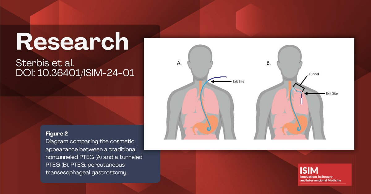 Research article by Sterbis et al. explores "Tunneled Percutaneous Transesophageal Gastrostomy for Treatment of Malignant Bowel Obstruction"doi.org/10.36401/ISIM-… #malignantbowelobstruction #gastrostomy #tunneledcatheter