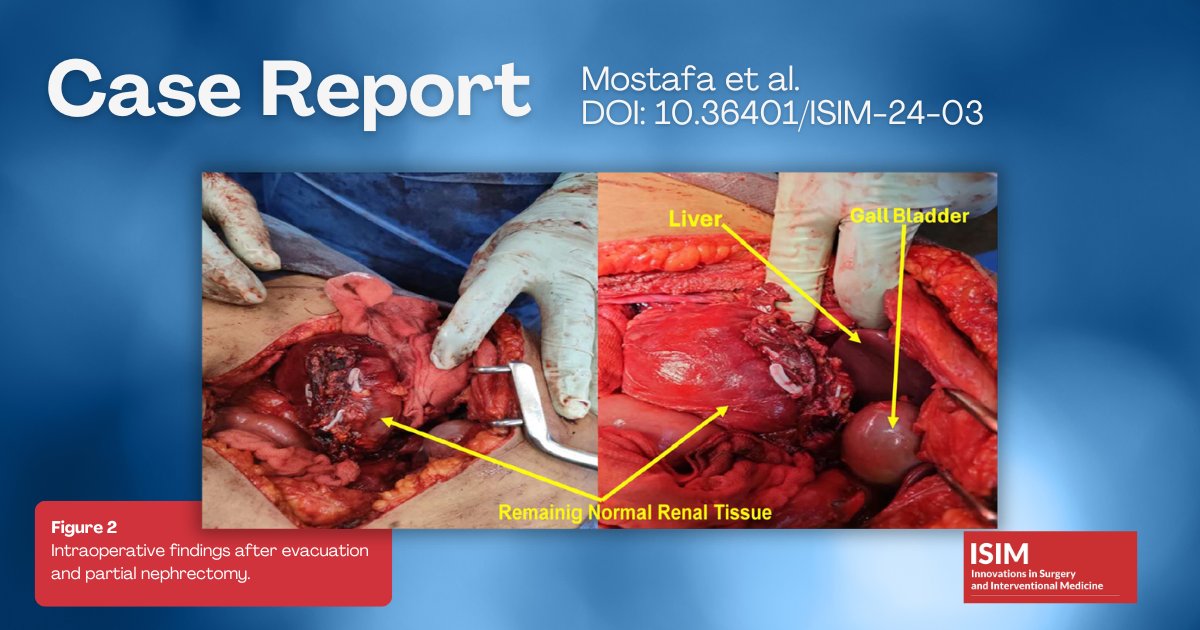 #ISIMJournal case report by Mostafa et al. highlights "Ruptured #pseudoaneurysm in a renal #angiomyolipoma: case report and literature review" doi.org/10.36401/ISIM-… #hematoma #perinephriccollection