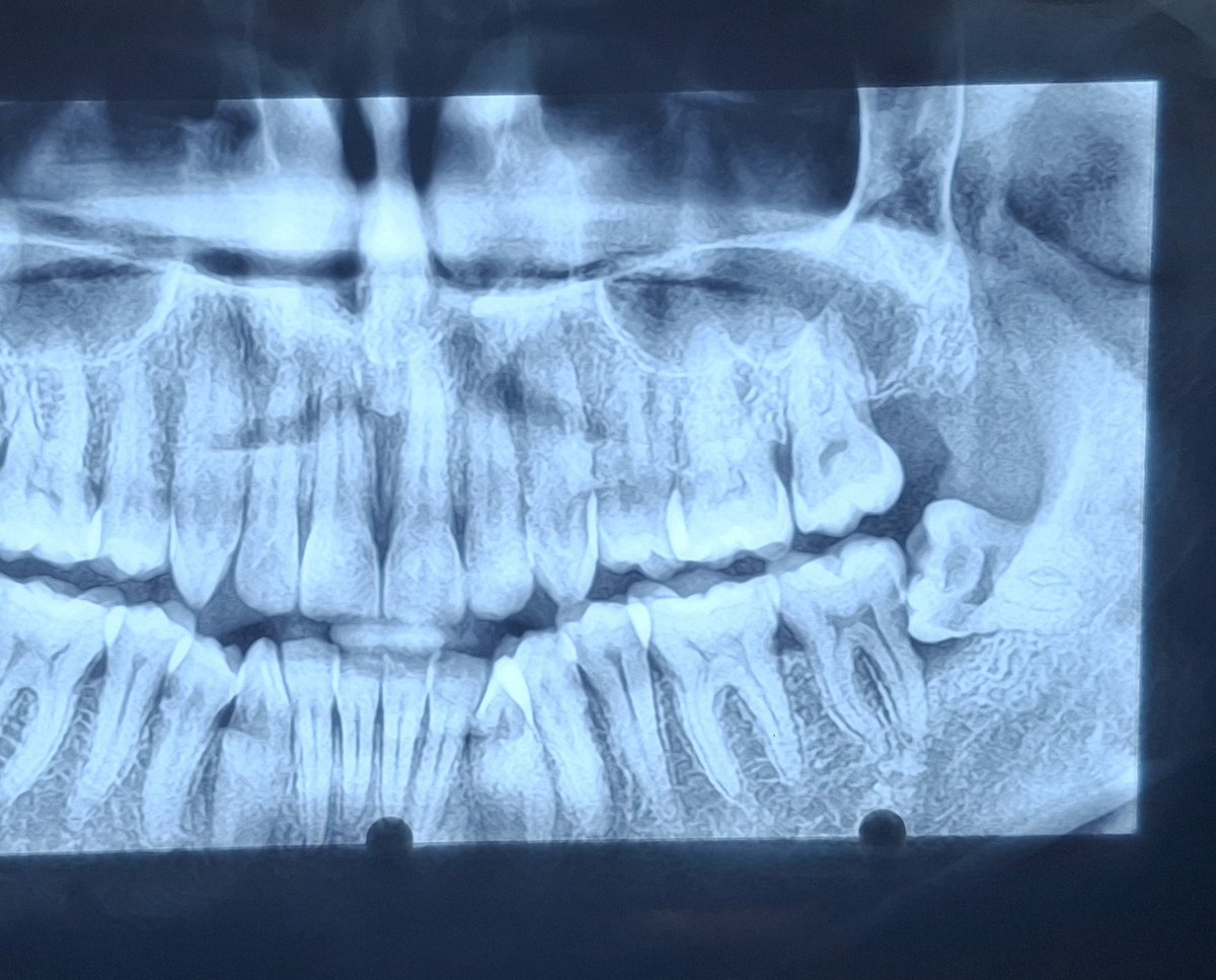 astrasurgeon's tweet photo. @RahulThanvi Did one today... Mesio going good. https://t.co/w6wgB9vAVa