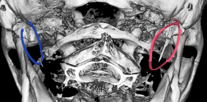 Happy Halloween! I can't describe my joy at finding a probable cause for my woes over the past few years, and it's both funny and creepy. Stylohyoid syndrome (Eagle-Sterling syndrome). Now I can joke about having a pain in the back of my head. Wishing you good health!