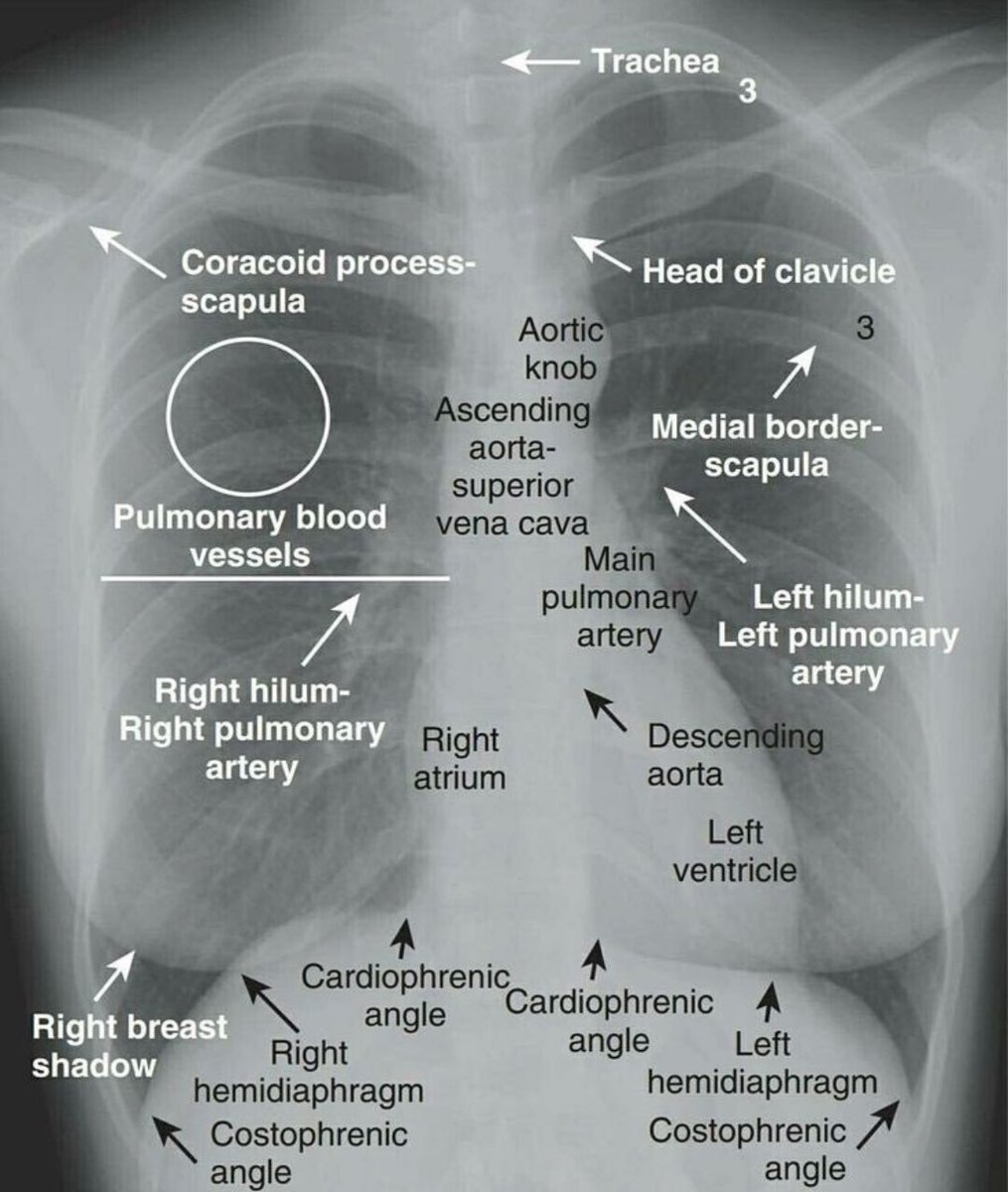 TrackYourHeart's tweet image. Normal chest x-ray with structural identification