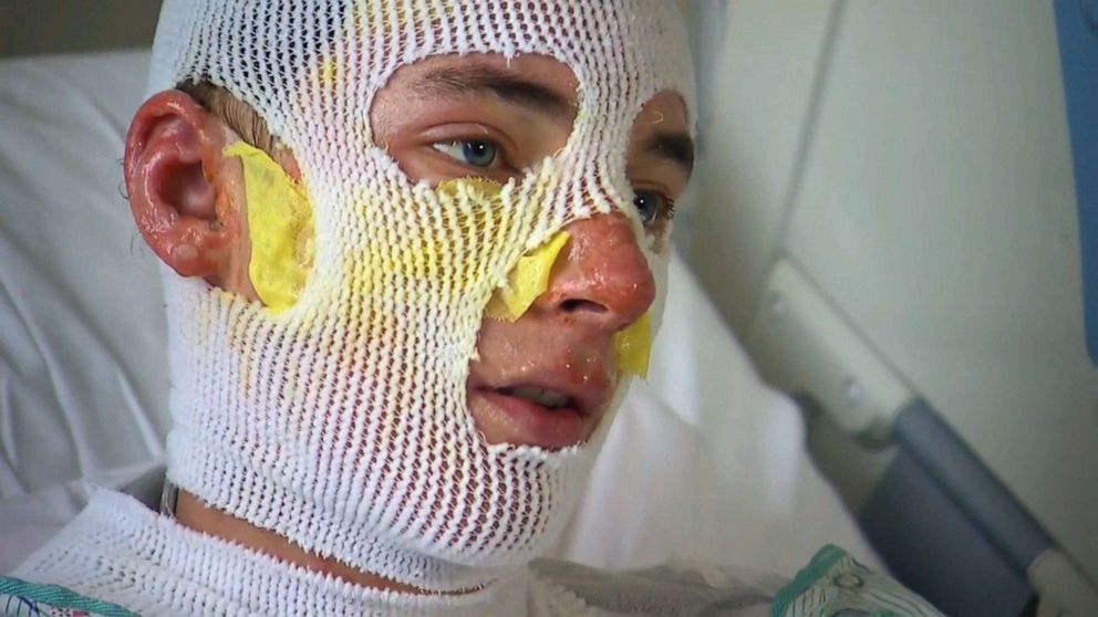 HumanityChad's tweet image. Derrick Byrd, 20, sustained second- and third-degree burns on his face, arms, and back after rushing back into a burning home to save his 8-year-old niece.

Derrick Byrd is the definition of a true hero. 🙏