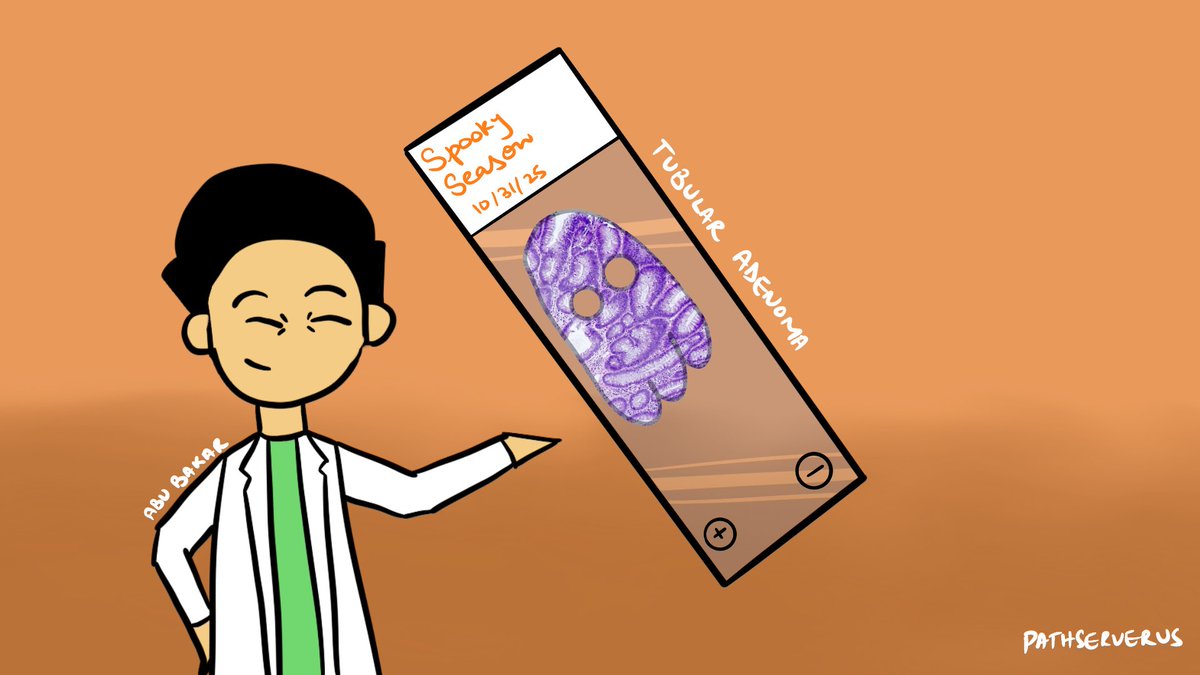 PathServerUS's tweet image. Here’s my favorite case which I got to see a lot during my time at HCA Tomball with @siddsheikh !

🔬 Tubular Adenoma 

#Pathoween #PathX #PathArt #MedTwitter