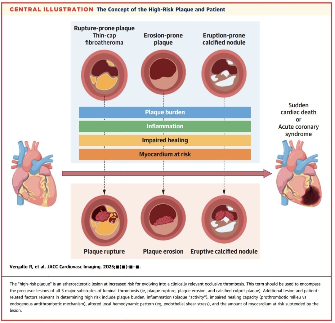 javier20ch's tweet image. Placa de alto riesgo. 🔎🫀💥
🎃La placa de alto riesgo redefine el concepto de vulnerabilidad coronaria, integrando morfología, biología y hemodinámica. Su detección temprana mediante imagen avanzada y terapia intensiva representa el nuevo eje en la prevención del infarto y la…