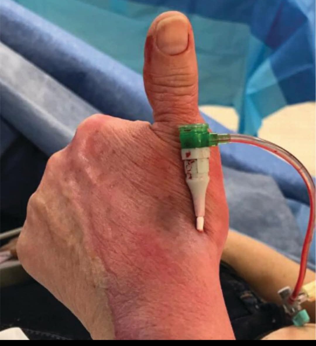 PeerNaveed12's tweet image. Thumbs up from the lab, we’re calling it a wrap! 👍 Have a great weekend, everyone!
#cathlab #cardiology #cathlabtech